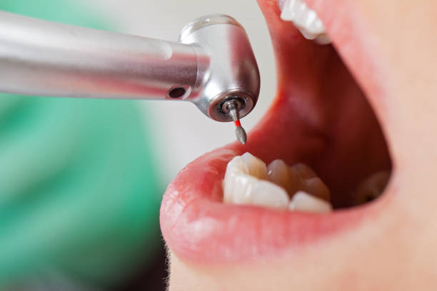 Best Knocked-Out Tooth (Avulsed Tooth) Treatment in Ramblewood, NJ